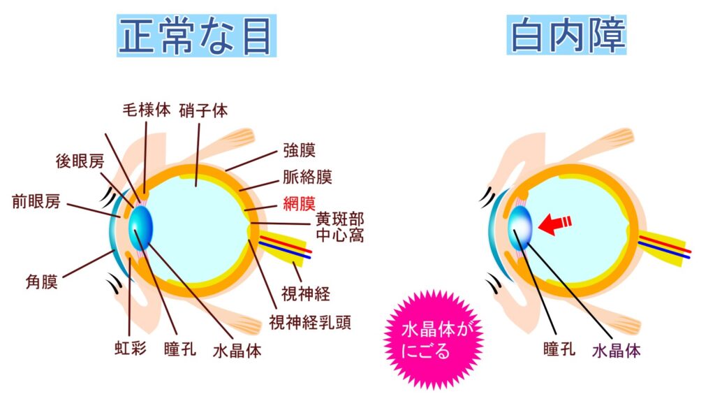 正常な目と白内障の目