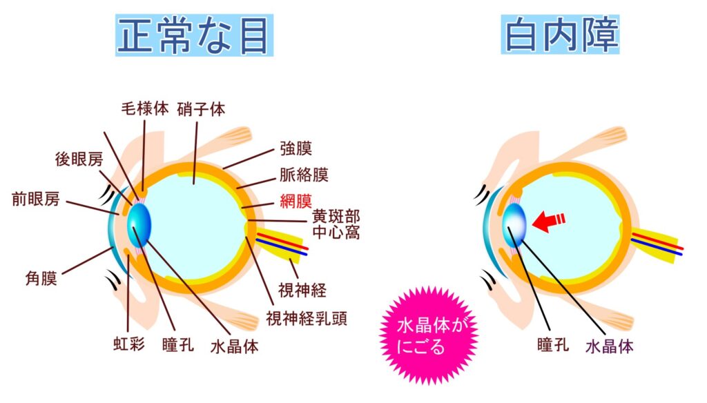 正常な目と白内障の目