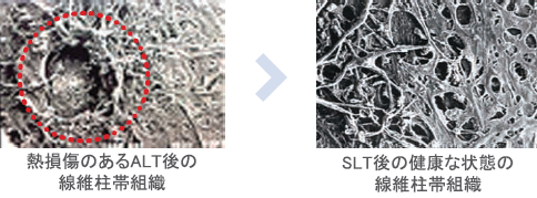 ALT後とSLT後の線維柱帯組織
