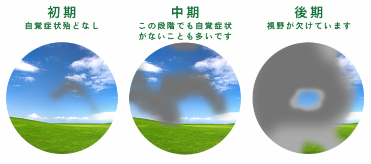 緑内障のイメージ画像