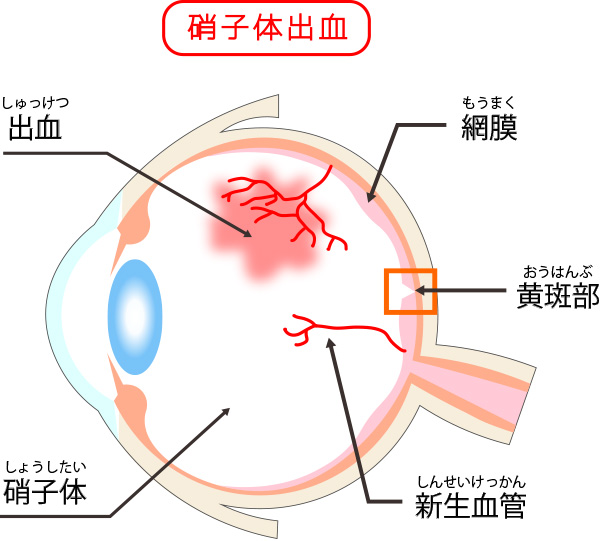 硝子体出血のイメージ画像