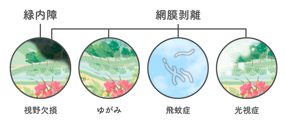 視野が欠けている原因と症状