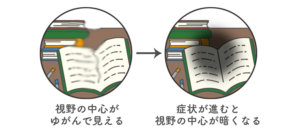 モノがゆがんで見える原因と症状