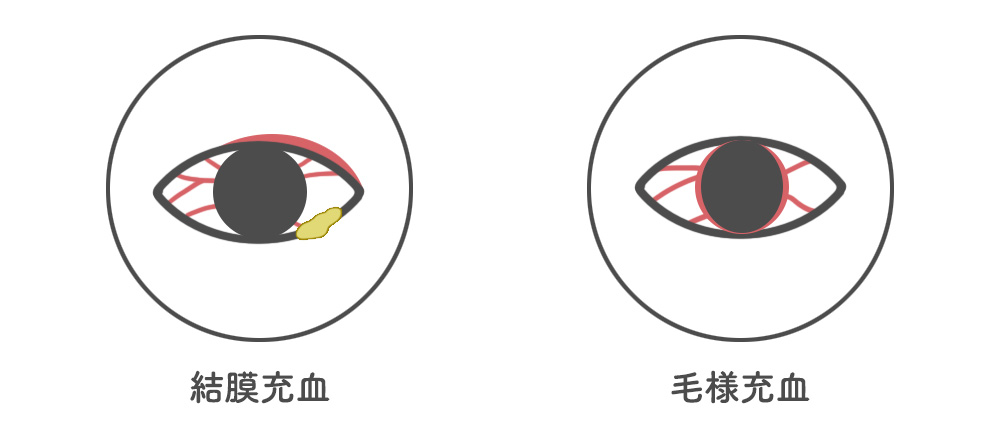 赤い 目 病気 が 「ずっと目が赤い」は要注意！充血に隠された視力低下の原因