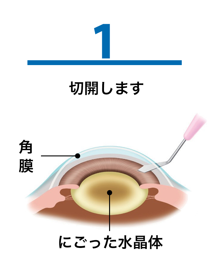 1.水晶体前嚢を切開のイメージ画像