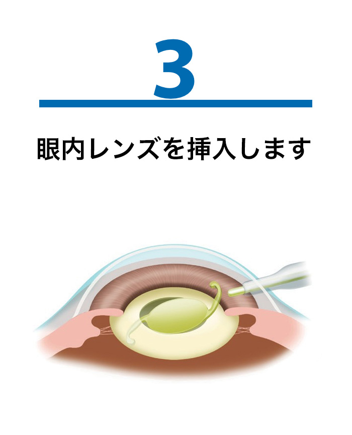 3.眼内レンズの挿入のイメージ画像