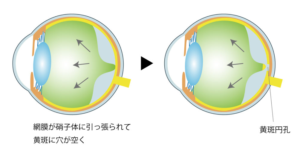 黄斑円孔