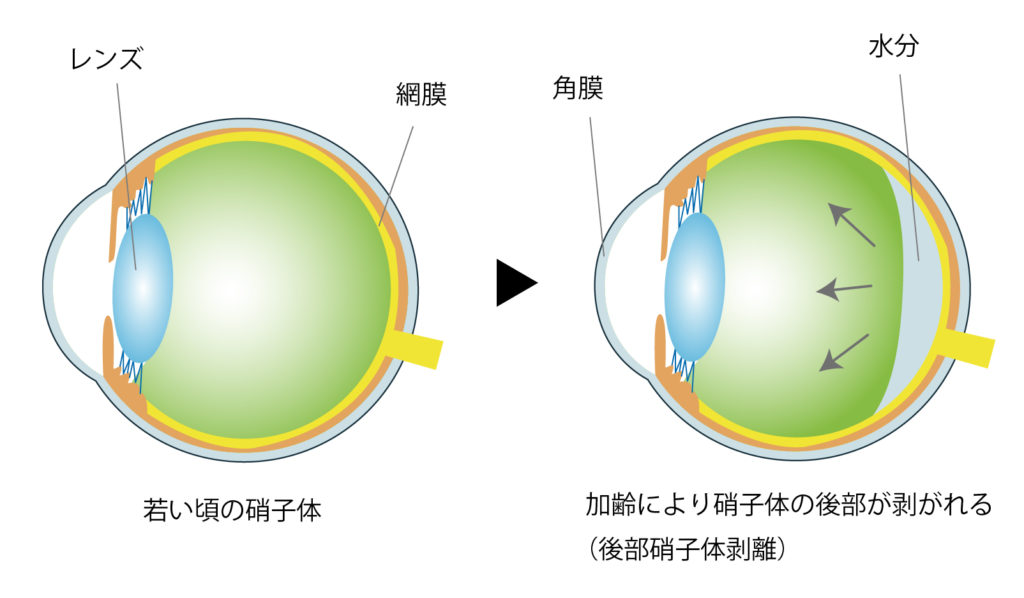 後部硝子体剥離