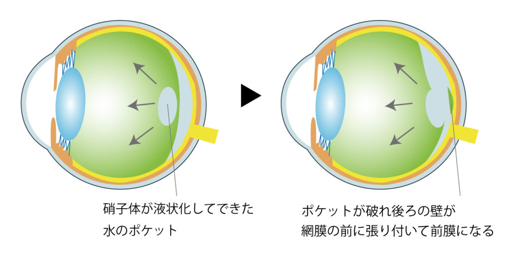 物 が ゆがん で 見える 脳