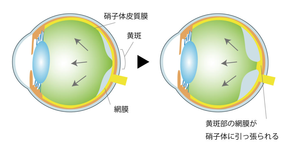 硝子体黄斑牽引症候群