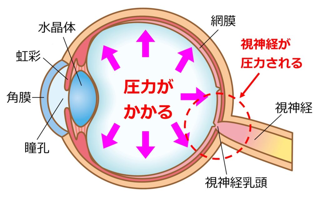 緑内障の原因